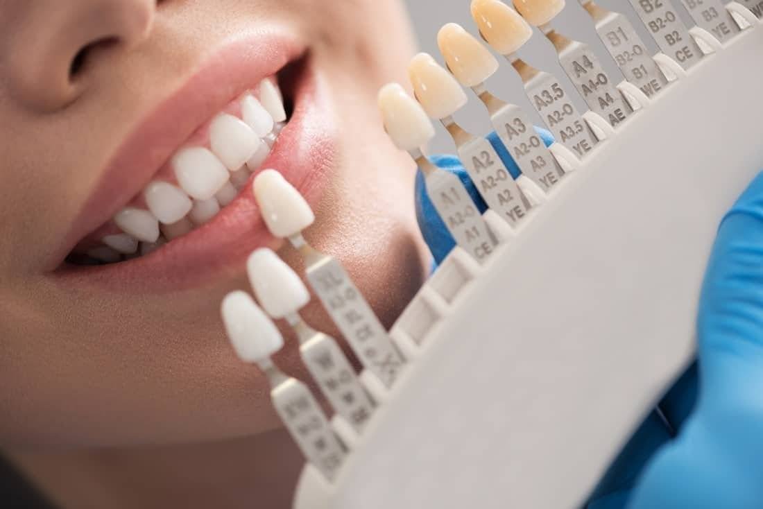 dentist matching the color of womans teeth for dental crown