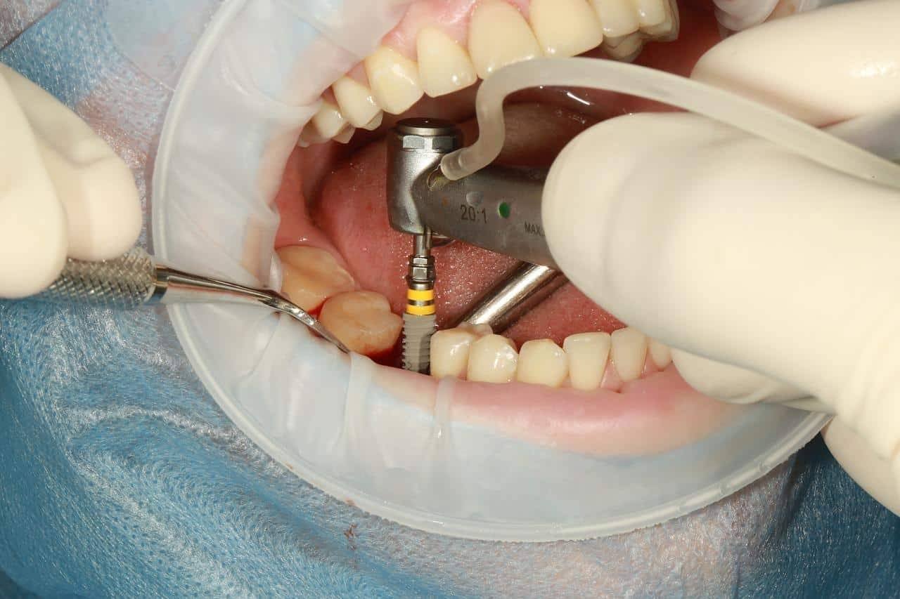 bad dental implants