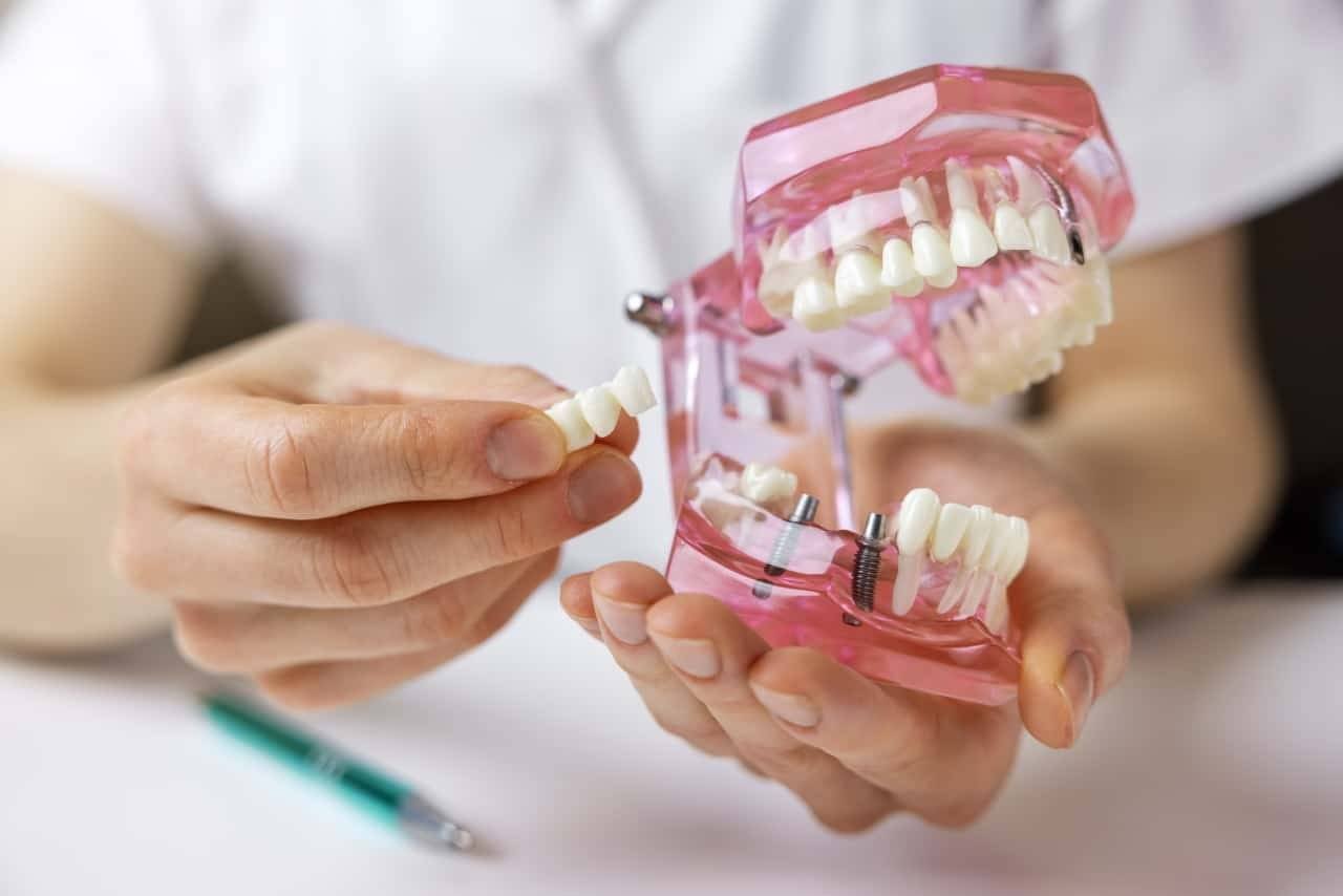 cost of dental bridge vs implant